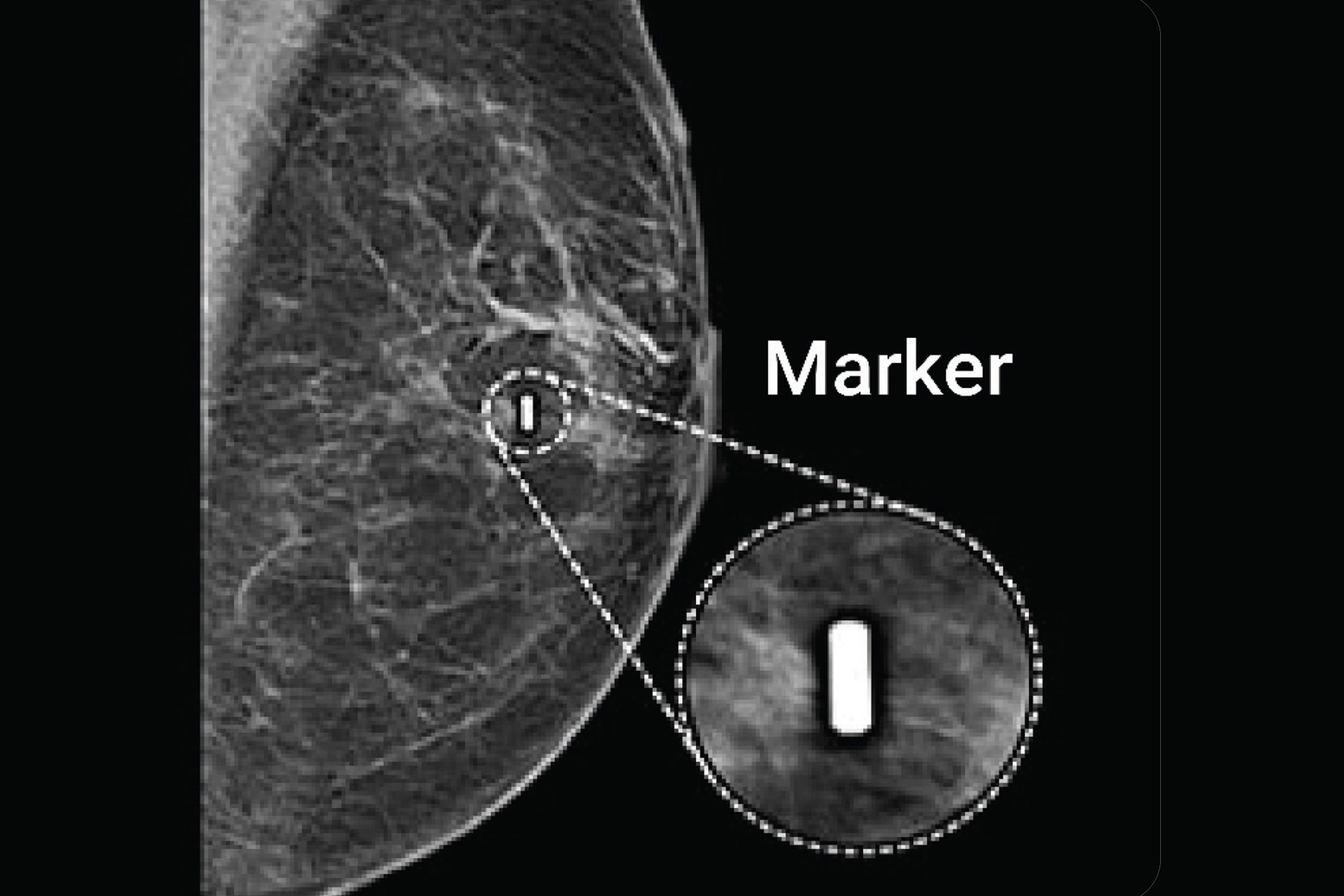 An authoritative overview of breast markers used in breast cancer care, including biopsy clips and magnetic seeds, and how they support accurate surgical localization.
