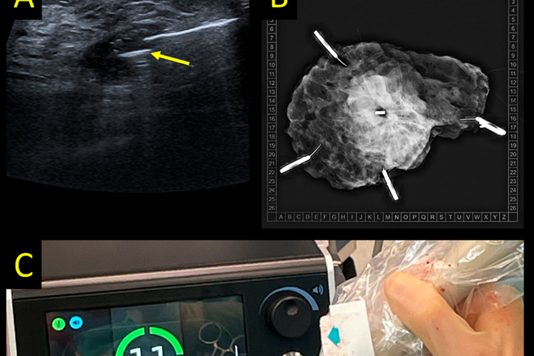 Learn how clip visibility in breast cancer imaging affects diagnosis, localization and surgery. A practical guide for radiologists and surgeons.
